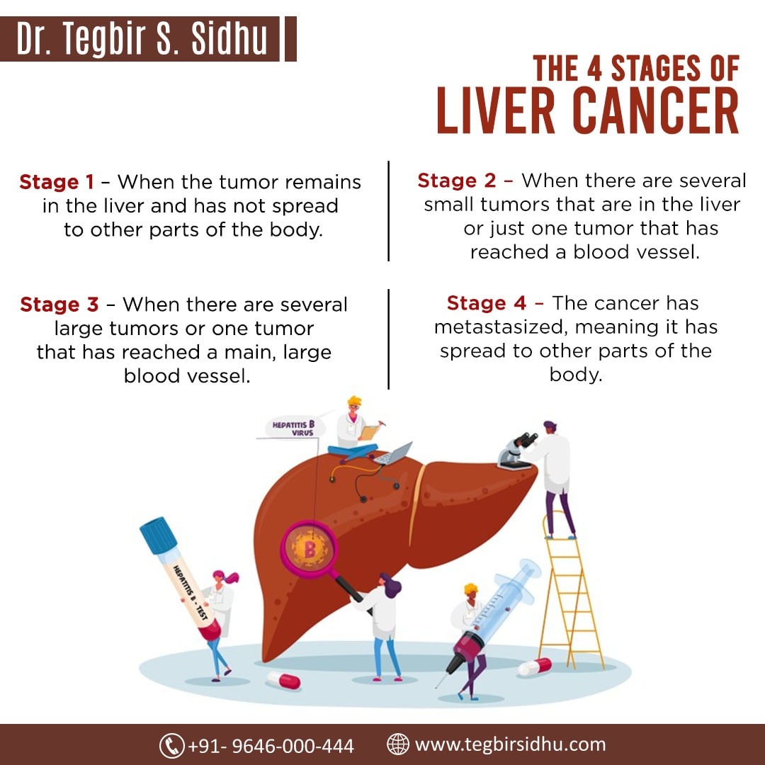 Liver cancer treatments best doctor